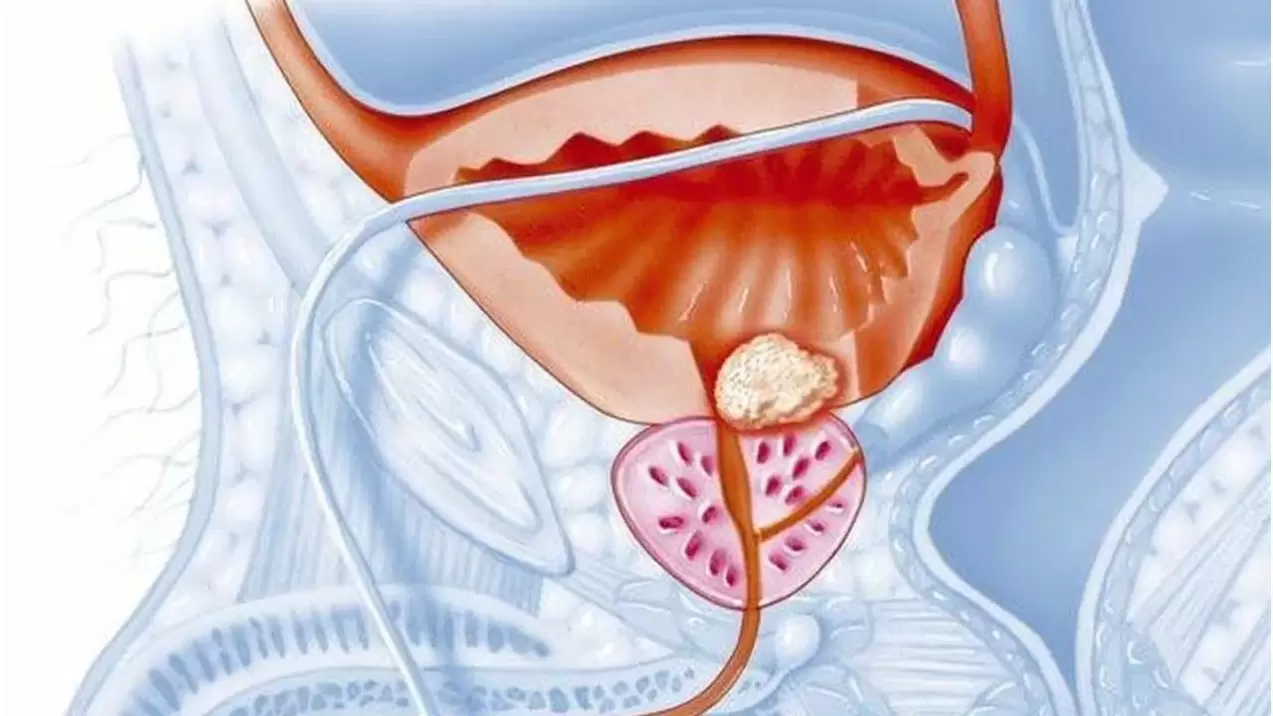 Malattia della prostata negli uomini